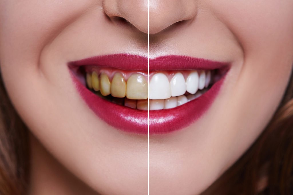 how-much-do-veneers-cost